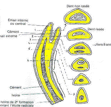usure des dents et composition